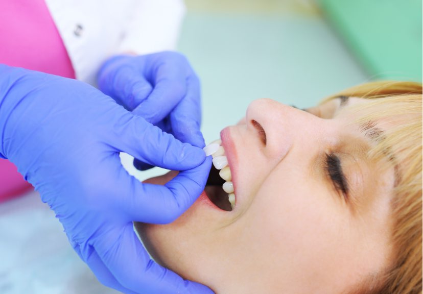 News_faccette | Studio dentistico a Bellusco e Gaggiano