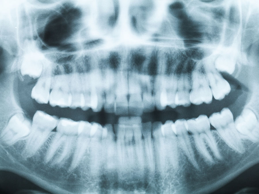 Ortopantomografia | Studio dentistico a Bellusco e Gaggiano